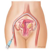 Fibroids Treatment India